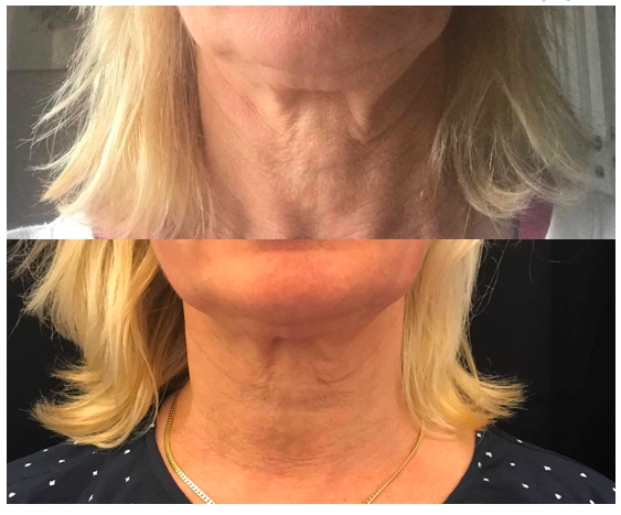 Före och en månad efter Ultra V Trådlyft behandling av hals